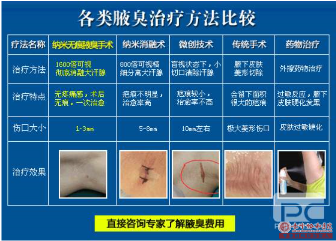 大连林西县腋臭的形成原因是哪些